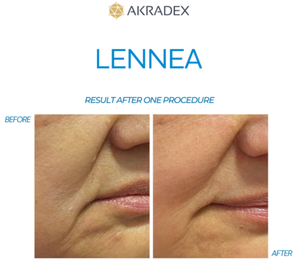 Lennea booster before after results