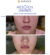 Before after photos for mesoten aqualight 2