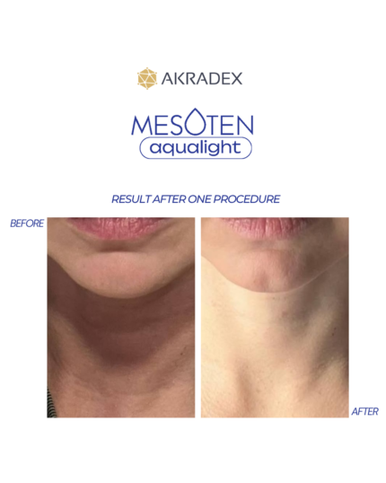 Before after photos for mesoten aqualight