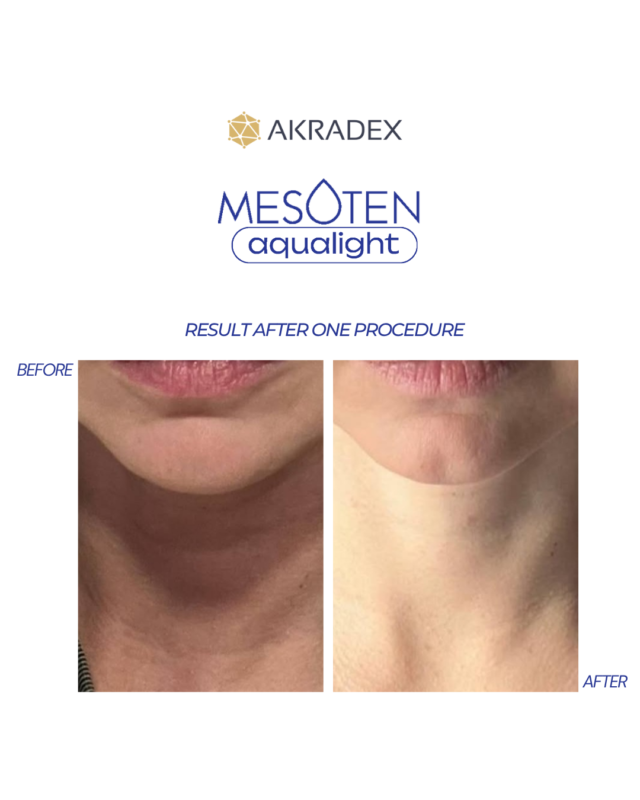 Before after photos for mesoten aqualight
