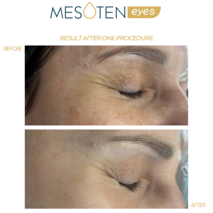 Mesoten Eyes before after results