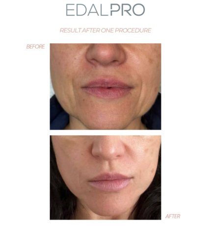 EdalPro before after results