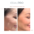 Before and after eye-area wrinkle results following one EdalPro procedure by Akradex.