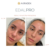 Before and after full-face results following one EdalPro procedure by Akradex.