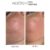 Mesoten Exopeptide before after results cheek