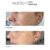 Mesoten Exopeptide before after results cheek longshot