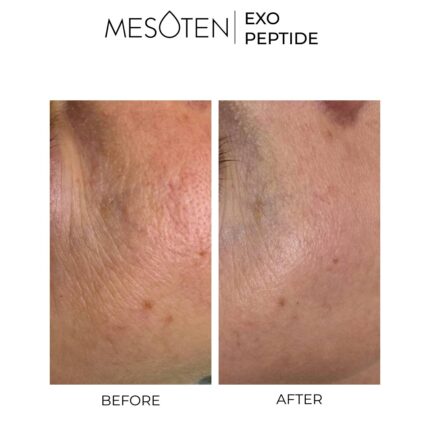 Mesoten Exopeptide before after results
