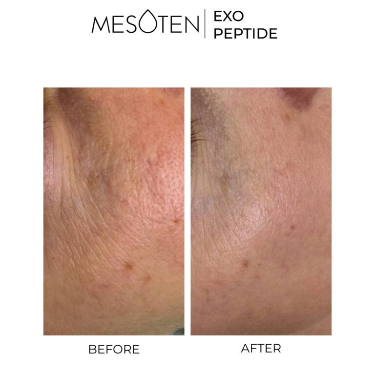Mesoten Exopeptide before after results