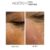 Mesoten Exopeptide before after results under eye