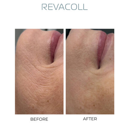 Revacoll before after results