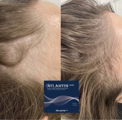 Atlantis hair before after side view results
