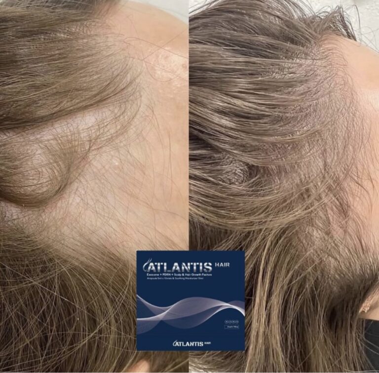 Atlantis hair before after side view results