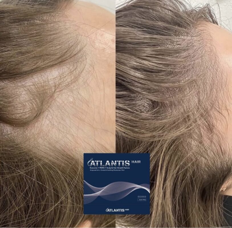 Atlantis hair before after side view results