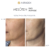 Mesoten Exopeptide before after results chin