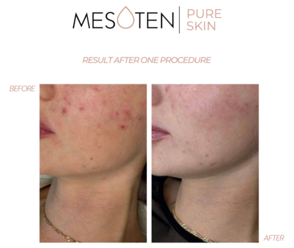 Mesoten Pure skin chin before after results