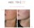 Mesoten Pure skin chin before after results
