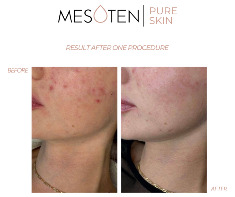 Mesoten Pure skin chin before after results